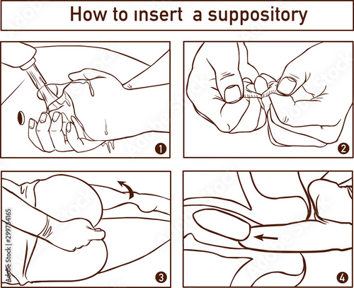Drawing to show the location and technique of suppository insertion for the delivery of drugs per rectum photo