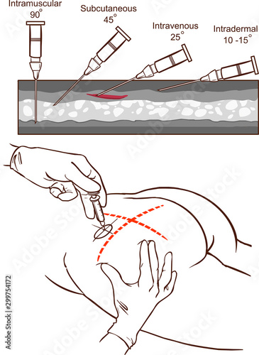 Intramuscular injection vector illustration and   Comparison of the angles of intramuscular injection.