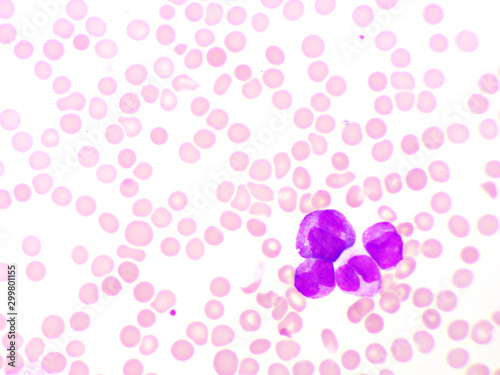 Blood picture of acute promyelocytic leukemia or APL, analyze by microscope, original magnification 1000x photo