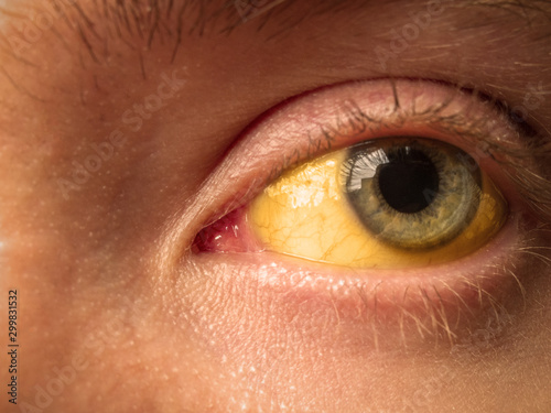 Obraz na płótnie yellow staining of the sclera of the eye in diseases of the liver, cirrhosis, he