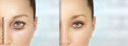 Lower and upper Blepharoplasty.Marking the face.Perforation lines on females face, plastic surgery concept. photo