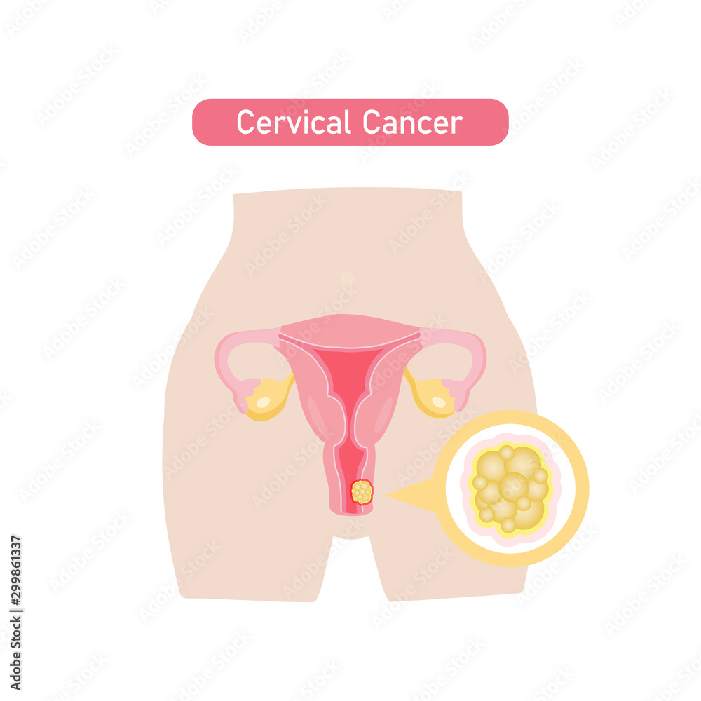 Obraz premium Cervical cancer in flat design.