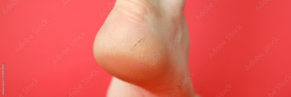 Fototapeta premium Heel with a cracked skin disease on a red