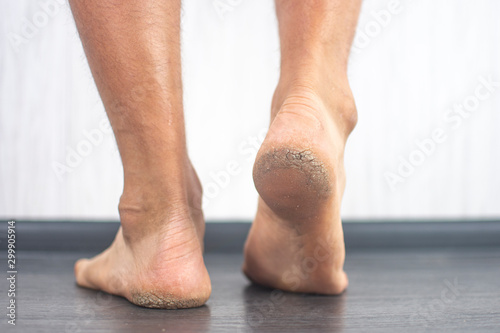 Feet with dry skin. Cracked heels.