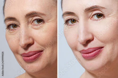 Middle age close up woman happy face before after cosmetic procedures. Skin care for wrinkled face. Before-after anti-aging facelift treatment. Facial skincare and contouring. Beauty photo