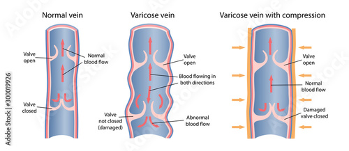 Treatment of varicose veins by compression. The scheme of venous circulation with normal and varicose veins. A longitudinal section of a vein with a description of the main parts. Vector illustration