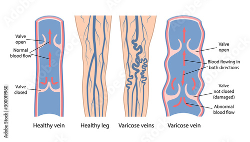 Varicose veins. Image of healthy and diseased legs. A longitudinal section of a vein with a description of the main parts. Vector illustration in flat style photo