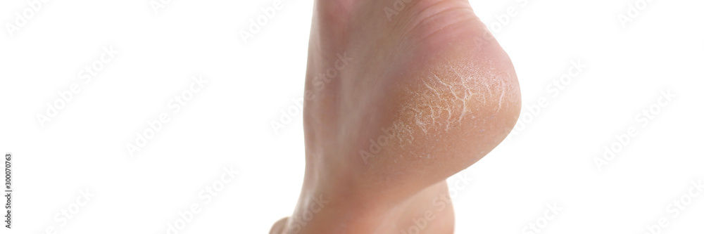 The heel of foot with bad skin covered with cracks The heel of foot with bad skin covered with cracks