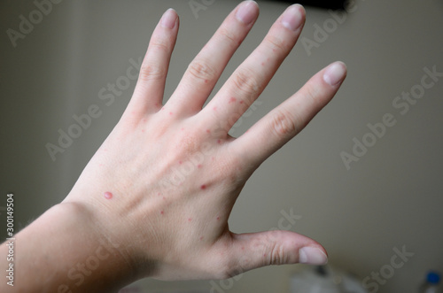 Hand, foot and mouth disease