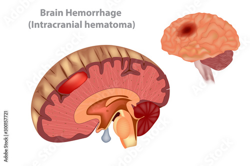 Brain Hemorrhage (Intracranial hematoma) Vector photo