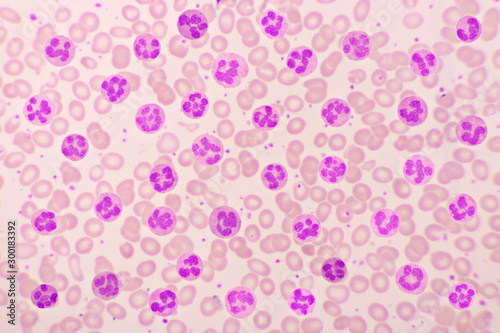 Variation of normal neutrophil cells or PMN cells in blood smear, analyze by microscope, original magnification 1000x photo