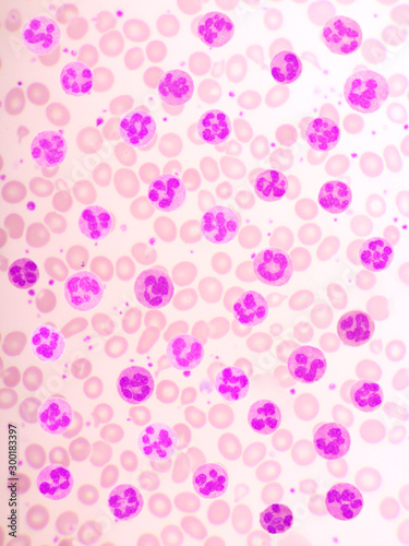 Variation of normal neutrophil cells or PMN cells in blood smear, analyze by microscope, original magnification 1000x