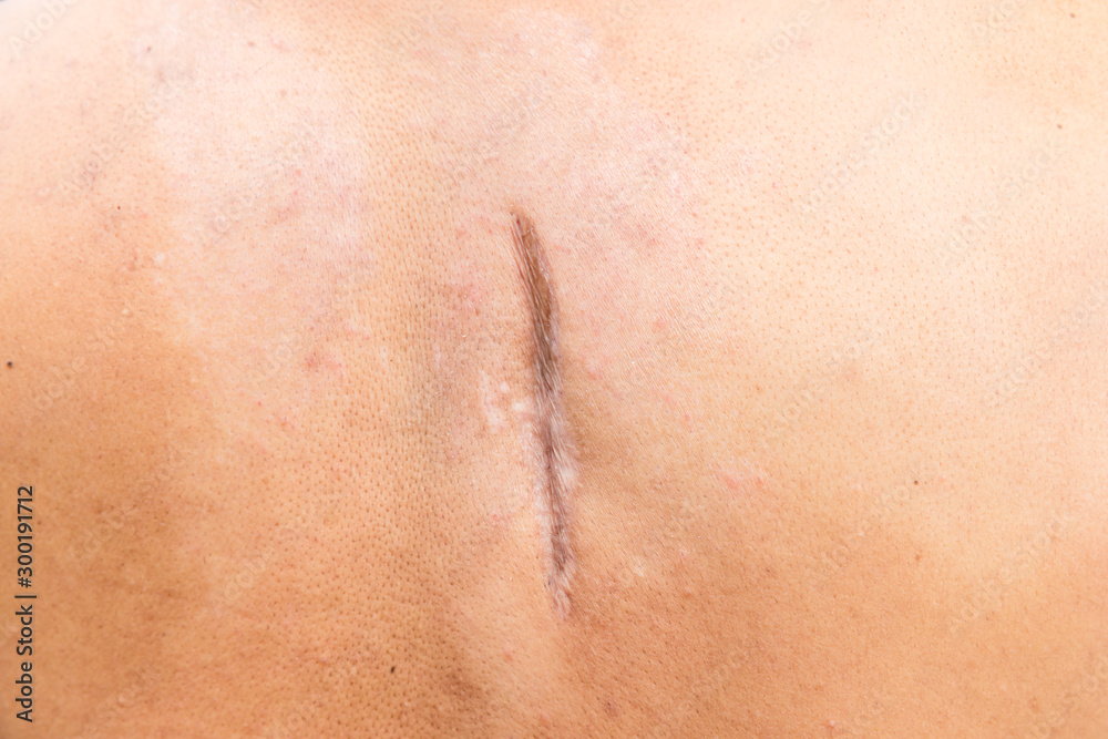 Fototapeta premium Raised scar. scar after appendectomy. cyanotic keloid scar caused by surgery and suturing, skin imperfections or defects. Hypertrophic Scar on skin