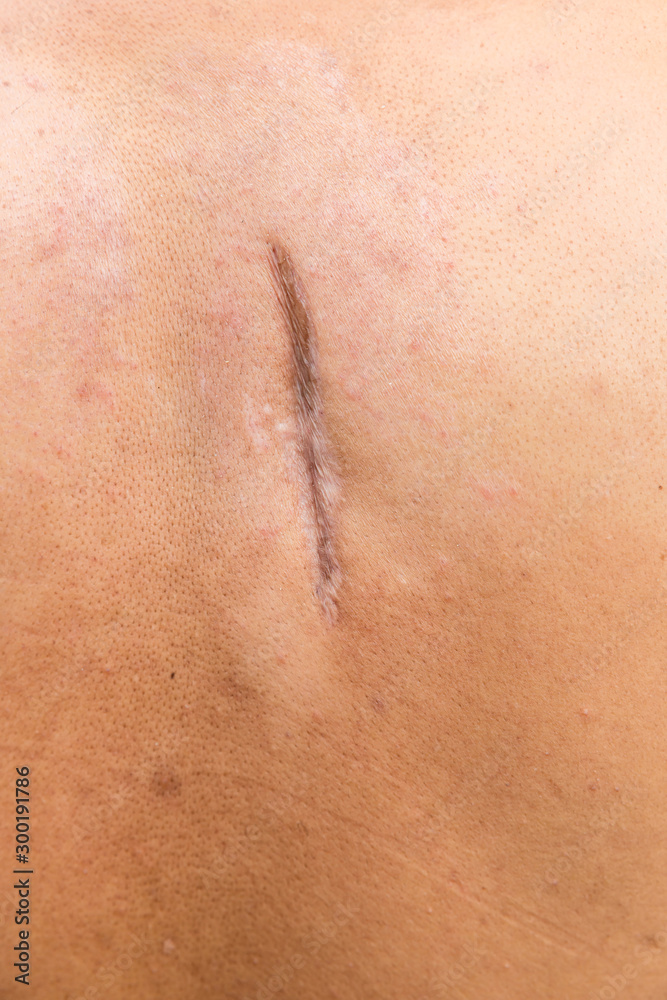 Fototapeta premium Raised scar. scar after appendectomy. cyanotic keloid scar caused by surgery and suturing, skin imperfections or defects. Hypertrophic Scar on skin