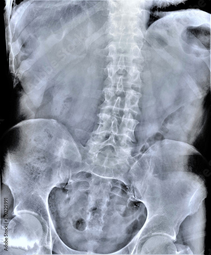 radiography of lumbar and sacral spine, pelvis, coxarthrosis, medical diagnostics photo