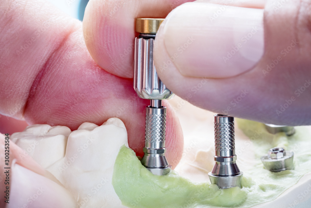 Closeup/ Convertible abutment components/ Dental implant temporary abutment/ Abutment screw