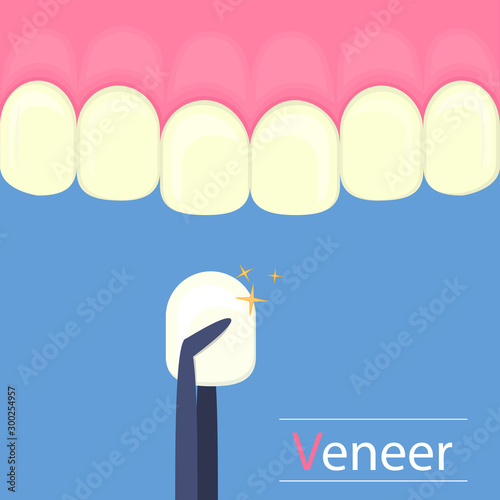 Dental veneers on a human tooth.