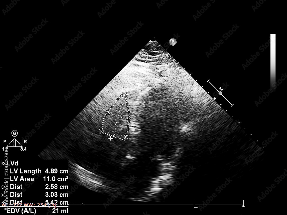 Screen of echocardiography (ultrasound) machine. Stock Photo | Adobe Stock