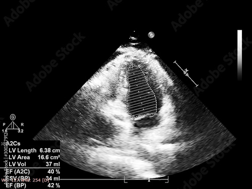 Screen of echocardiography (ultrasound) machine. © faustasyan