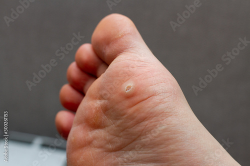 Wart on the foot. 