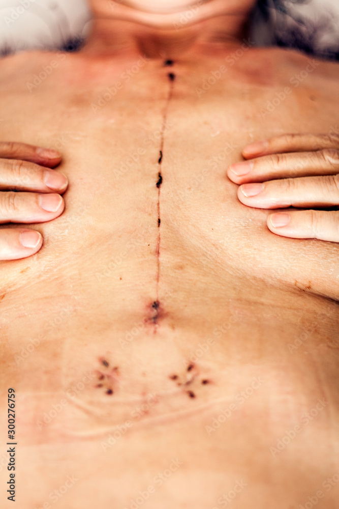 Naklejka premium Scar from open heart surgery on the female body, where the sternum was cut in two, and the rib cage sprung. Image taken 30 days (1 month) following surgery.
