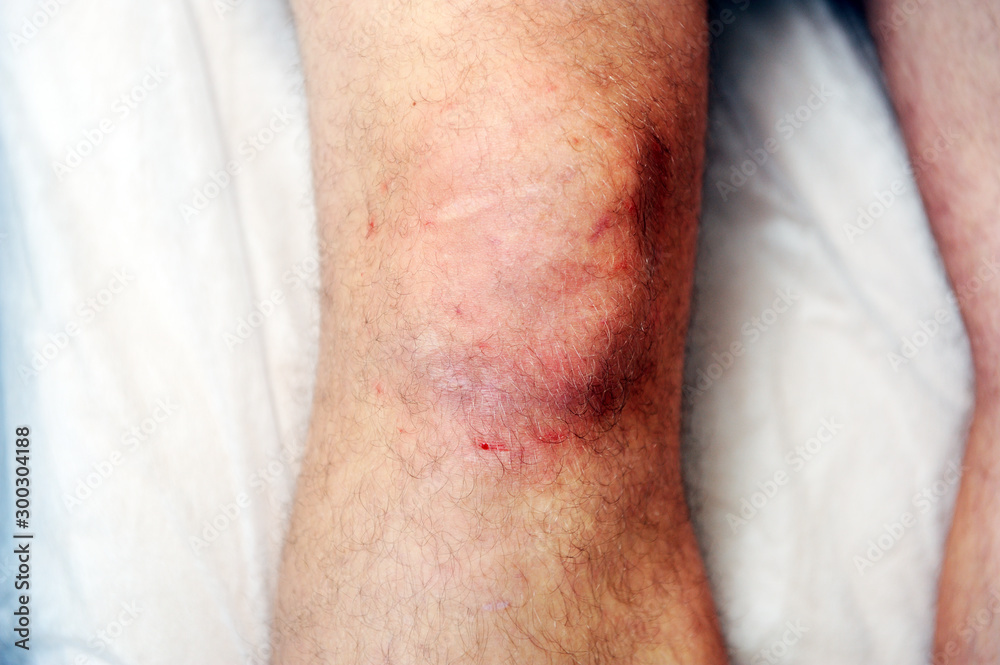 Naklejka premium Reddened skin on the knee after carbon dioxide therapy (carboxytherapy)