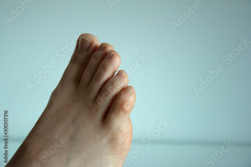 Corn on the little toe of a foot against white background.