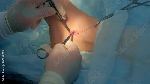 Surgeon sews wound on leg after surgery using self-absorbable threads, hands closeup. Doctor sutures ankle during surgery with neat stitches after removing hygroma. One day surgery concept.