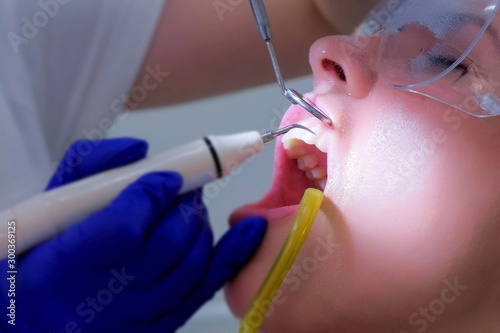 Stomatologist dentist makes ultrasonic cleaning teeth to young woman in stomatology clinic, closeup view. Patient woman visit dentist on ultrasound teeth brushing procedure in dentistry. Oral hygiene.