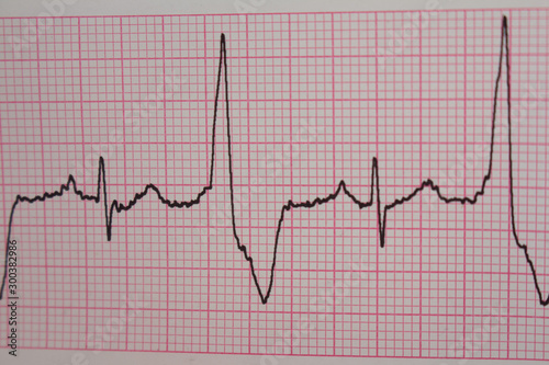 Heartbeats recorded on an electrocardiogram. cardiac arrhythmia.