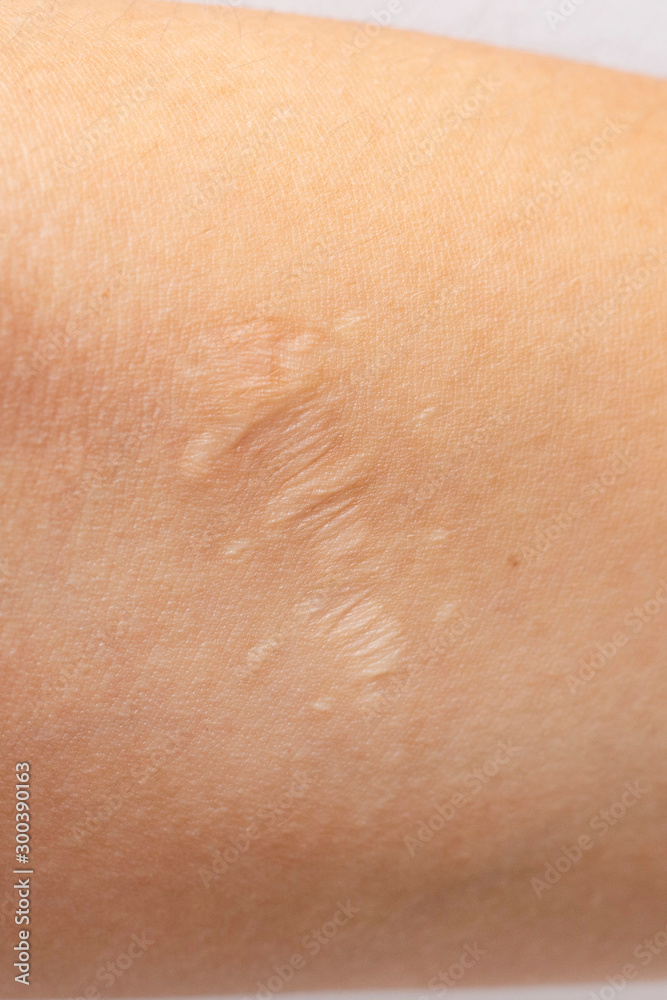old scar on human skin. sewn scar, four sutures. laceration, suturing.