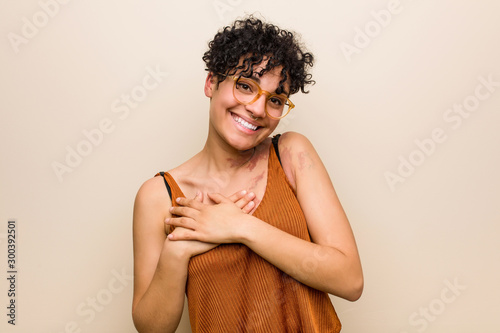 Young african american woman with skin birth mark laughing keeping hands on heart, concept of happiness.