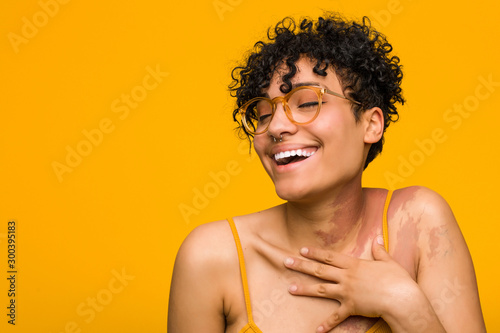 Young african american woman with skin birth mark laughs out loudly keeping hand on chest.