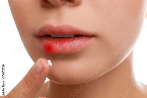 Young woman with cold sore applying cream onto lips against white background  closeup