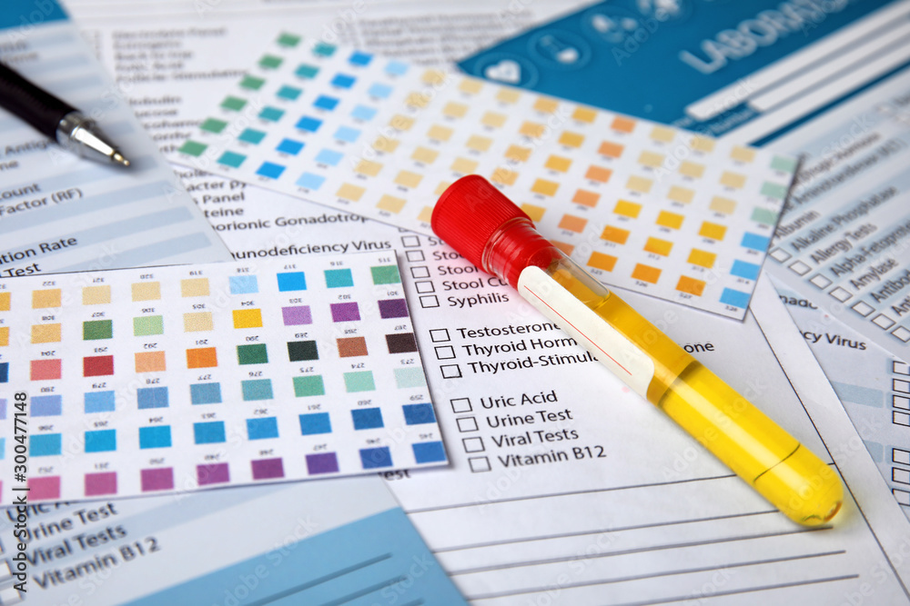 Test tube with urine sample for analysis on laboratory test form Test tube with urine sample for analysis on laboratory test form