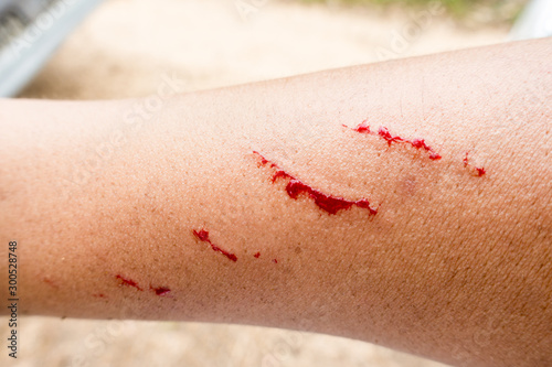 Selective focus of fresh wound with blood, A man showing a lesion under his arm, Accident wound marks on the left hand side, Injuries from falling on street.