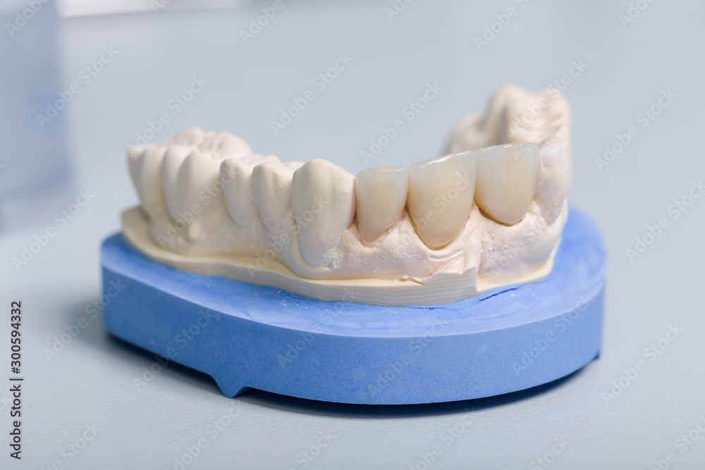 Dental imprint with artificial dentition in a dental laboratory Dental imprint with artificial dentition in a dental laboratory