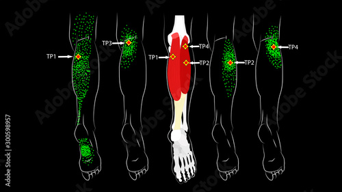 Calf muscle. Trigger points in the leg, reflected pain on the back of the thigh and in the foot. Leg pain