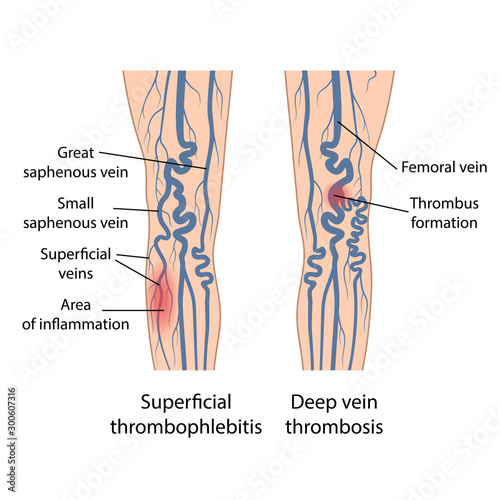 Superficial thrombophlebitis of legs. Deep vein thrombosis. Image of diseased legs. Vector illustration in flat style isolated on white background