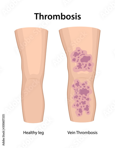 Thrombophlebitis of legs. Thrombosis. Image of healthy and diseased legs. Vector illustration in flat style isolated on white background