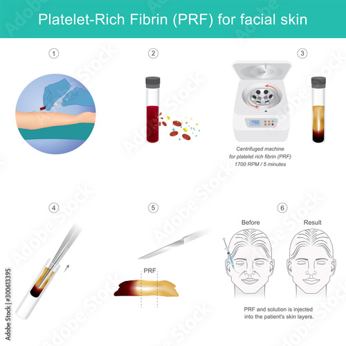 Platelet rich fibrin for facial skin. Illustration explain Technology treatment medical facial skin from stem cells for make anti-aging serum.