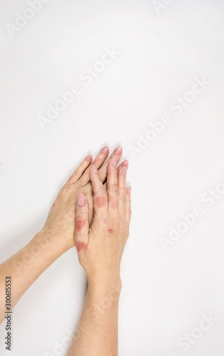 Eczema on the hands. Female hands affected by dermatitis. Close-up.