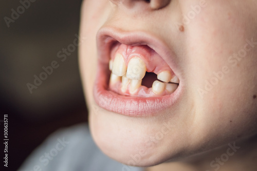Closeup mounth of 8 years old kid  european boy showing temporary baby milk teeth missing  childhood and dentistry or medical concept  tooth care  natural light shot at daytime