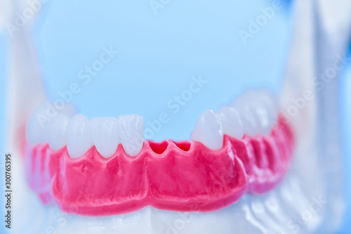 Tooth implant and crown installation process