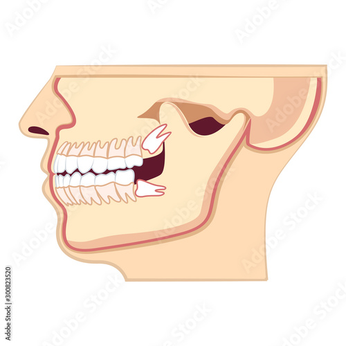 Human head with with jaw. Abnormal eruption of the teeth, dental