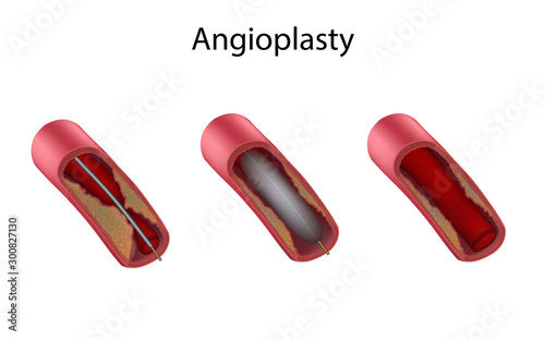 Ballon angioplasty stages. Atherosclerosis plaques. Medical anatomy illustration. photo