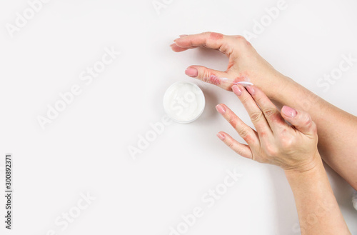 A woman applies cream to her hands to treat dermatitis. Skin diseases. Close-up.