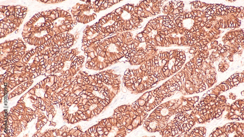 Photomicrograph of immunohistochemistry for HER2,  showing positive cell membrane staining in this infiltrating ductal carcinoma.   Candidate for Herceptin.