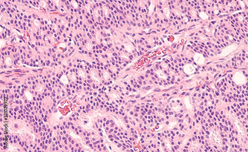 Prostate Cancer Oncology Awareness: Photomicrograph of core biopsy of prostate gland showing histology of adenocarcinoma in patient with elevated PSA. 