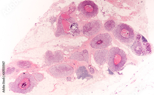 Breast biopsy of  ductal carcinoma in situ (DCIS), nuclear grade 3 with necrosis (comedocarcinoma in situ).  Cancer cells are confined to the mammary ducts, without invasion. 